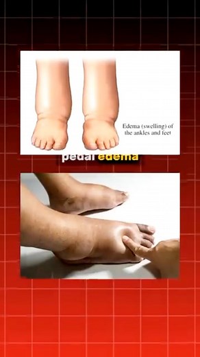 Dr Adrita Banerjee on Instagram: "@livinghealthy_docab - Struggling with swollen feet or ankles? You might be dealing with pedal edema a buildup of fluid in the lower legs and feet. Let’s break down what causes it and how to manage it naturally. 💧 What causes pedal edema: Prolonged standing or sitting, heart or kidney issues, certain medications, or even lifestyle factors can lead to swelling. 👉 Simple ways to reduce it: • Elevate your legs above heart level for 20–30 mins a few times a day • 