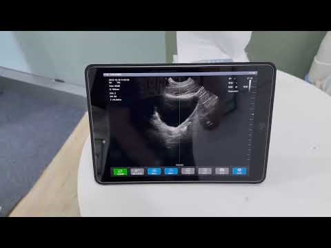 Bladder scanner , automatically detect the remaining urine volume #Ultrasound #Bladder