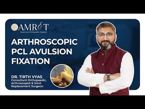 Arthroscopic PCL Avulsion Fixation | Dr. Tirth Vyas