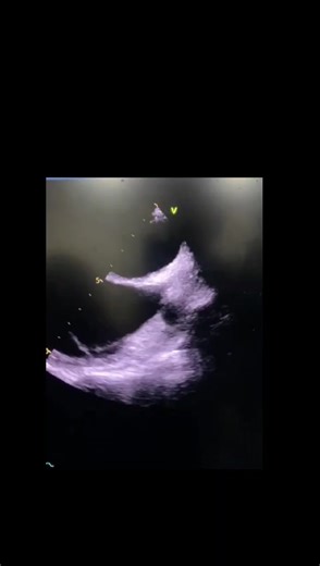 Bicaval View of Transesophageal Echocardiogram of 33 y old patient for assessment of interatrial septum showed nicely directed jet of superior vena cava through the right atrium #echocardiography #medicine #imaging #learn #fppppppppppppppppppp