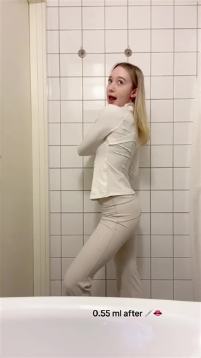 Lip Filler Experience Explained