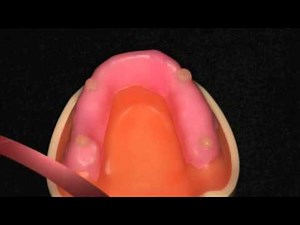 Custom tray fabrication for dental imprssions