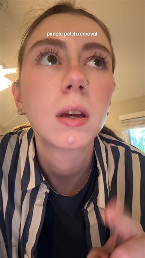 56K views · 183 reactions | Any tips to get rid of cystic acne？ This is new | Brc Construction | Facebook