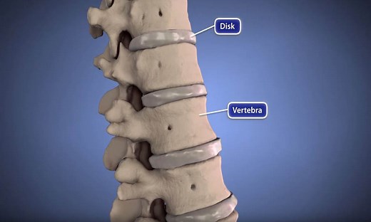 Herniated Disk Animation - OrthoInfo - AAOS