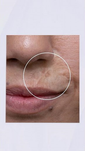 Scar Skin Treatment Result - Before & After Pico Laser #scartreatment