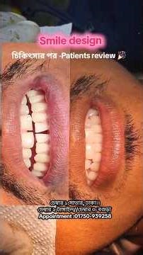 Front teeth gap treatment, Smile design #dentist #shorts