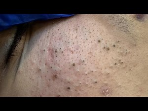 SATISFYING Pimple Popping & Deep Cleansing Techniques | Best Facial Care Routine