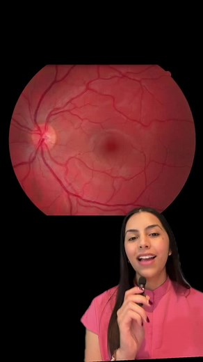 Ya conocias el desprendimiento de retina? 👁️👄👁️ (regmatogeno) #retina #desprendimientoderetina #opthalmology #eyes
