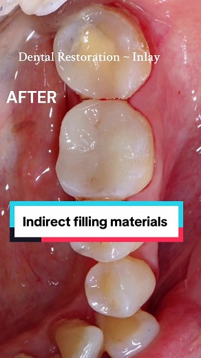 Dental Fillings: Composite vs. Inlay Procedure Explained