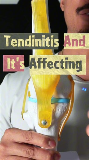 If patellar tendinitis is affecting your daily life not just volleyball this matters. Sitting too long. Stairs. Deep knee bends. Taking time off was the right call. Backward walking helped calm it down. But here’s the truth most people miss: rest reduces pain it doesn’t rebuild capacity. That’s why pain comes back the moment you jump or land again. The knee simply isn’t ready. The next step isn’t more rest. It’s controlled loading: • Slow tempo squats or split squats • Isometrics to settle pain 