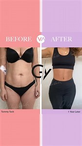 A detailed overview of tummy tuck surgery.