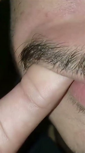 #ingrownhairremoval #beard #satisfying #thebarbersarms #removehair #odlysatisfying