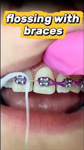The EASIEST way to floss with braces! 🦷🧵#braces #hygiene #dentist