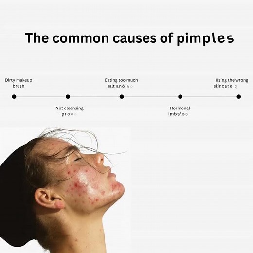 Top 5 Common Causes of Pimples | Why You Keep Breaking Out & How to Fix It