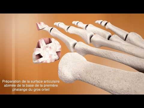 L'arthrodèse du gros orteil - Chirurgie du pied - Clinique du Parc Lyon