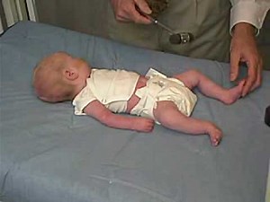 neurology exam: newborn-abnormal: Reflexes - Deep Tendon Reflexes