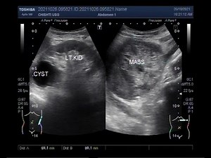 A large Adrenal tumor.