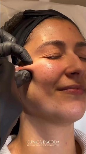 Tratamiento Profhilo facial mediante la técnica BAP #medicinaestetica #profhilo