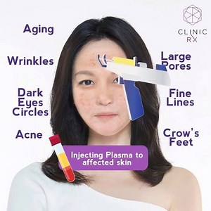 296K views · 1.1K reactions | PRP treatment, an all new innovative...