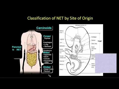 Current Management of Neuroendocrine Tumors at Mount Sinai