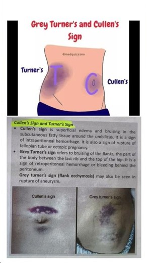Cullen's sign and Turner sign of pancreatitis #signs #education #rrbparamedical #msn #pancreas