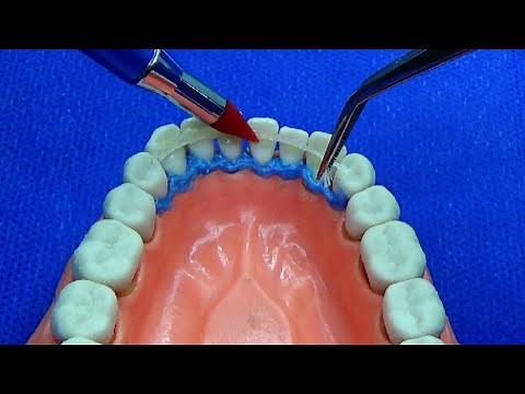 Splinting teeth with mobility/ Interlig fiberglass