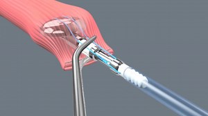 Use of a Circular Stapler in Laparoscopic Esophageal Surgery