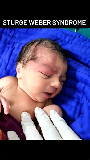 DR CHANDRARK DISHANK OZA on Instagram: "Sturge–Weber syndrome (SWS) is a rare, non-inherited neurovascular disorder that affects the brain, skin, and eyes. It's characterized by abnormal blood vessels, including a birthmark (port-wine stain) on the forehead or eyelid, and extra blood vessels on the brain's surface and sometimes in the eye. SWS is usually not life-threatening, but requires lifelong monitoring Sturge-Weber syndrome (SWS) is a rare, congenital neurological condition that affects bl