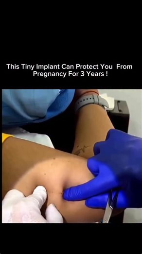 BIOLOGY | MEDICAL EXPLAINED on Instagram: "This tiny rod in your arm can prevent pregnancy for up to 3 years — no daily pills, no reminders, no stress. 💡 What it is: A matchstick-sized birth control implant placed just under the skin of your upper arm by a healthcare provider. 🧠 How it works (24/7): • Releases a low, steady dose of progestin • Stops ovulation • Thickens cervical mucus to block sperm • Thins the uterine lining ✨ Why many choose it: ✔ Over 99% effective ✔ Set-it-and-forget-it pr