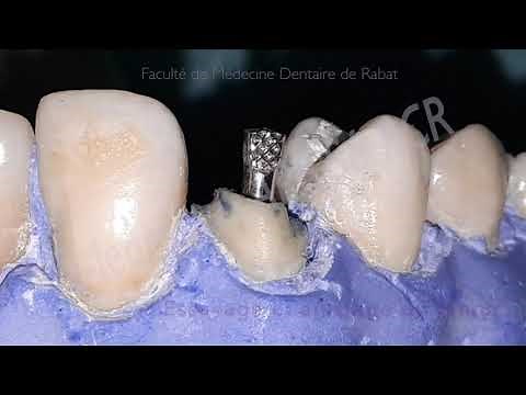 Préparation corono-radiculaire sur une dent monoradiculée + Provisoire à tenon
