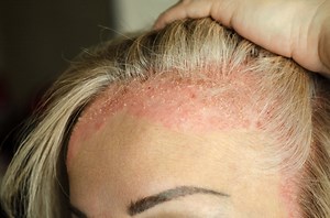 Psoriasis du cuir chevelu : quels symptômes ? Comment le traiter ?
