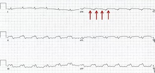 Trick of the Trade: Speed up ECG paper rate to differentiate tachycardias