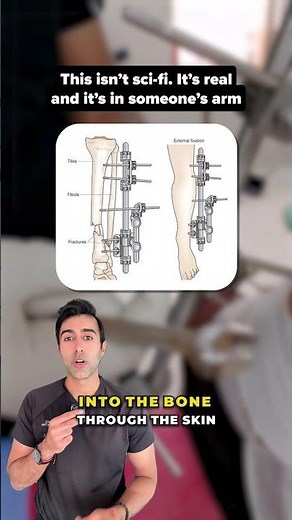 The Metal Frame That Helps Bones Heal