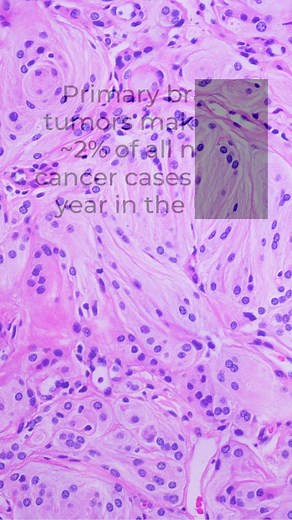 1.3K views · 15 reactions | May is Brain Tumor Awareness Month....