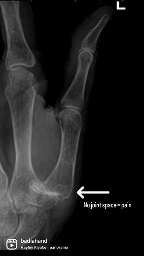 Biopro modular implant for base of the thumb arthritis - Impressive before and after xray!