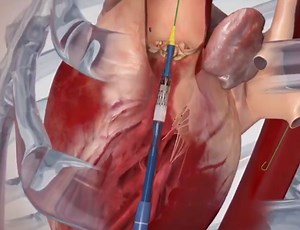 ▷ ¿Qué es TAVI? ¿Qué significa TAVI? - Cirugía Cardiovascular Sevilla - Dr. Gómez Vidal