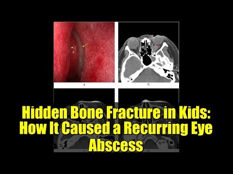 Hidden Bone Fracture in Kids: How It Caused a Recurring Eye Abscess