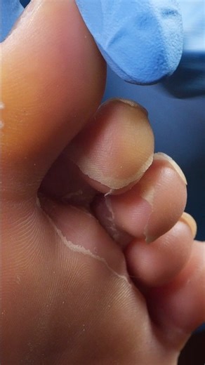 Satisfying Pedicure Callus Removal #satisfying #toenails