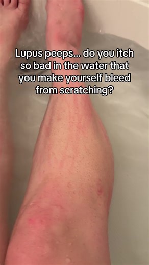 Managing Itchy Skin with Lupus: Relief Tips