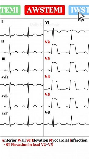 Acute Myocardial Infarction ECG made easy #ecg #cardiology #ecginterpretation #stemi