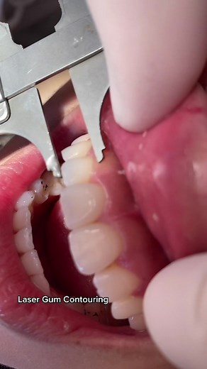 Laser Gum Contouring!!! #dentist #dentistry #veneers #gummysmile #gumlift #teeth #laser #fyp