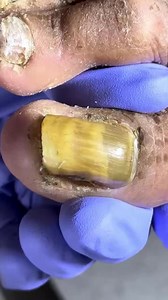 This toenail exposure shocked all viewers 7GFQ Beautiful moments of care and relaxation through a gentle pedicure experience. Simple, clean, and satisfying. 🌿✨ Disclaimer: This video is for educational and relaxation purposes only. All content belongs to the respective owners, no copyright infringement is intended. | Care ASMR