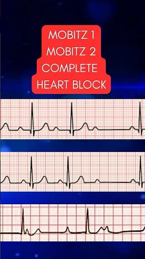Heart Blocks Made EASY | Heart Block Song #nclexstudyguide #nursingstudents #nursingschool