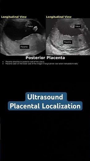 Ultrasound placental localization #ultrasound #doctor #mbbs #pregancyultrasound #baby
