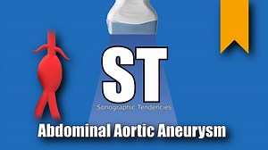 Abdominal Aortic Aneurysm