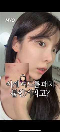 여드름 치료를 위한 트러블 패치 2가지 리뷰