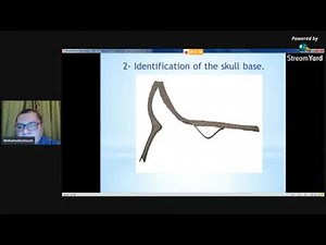 Frontal sinus surgery explained- Dr.Mohamed Tomoum