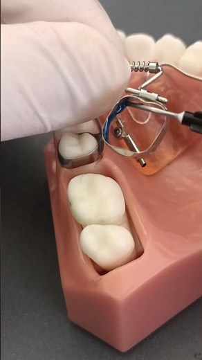 bond posterior tooth with molar band #dentist #smiledesigndental #satisfying #dentalfilling #teeth