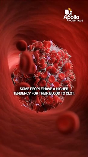 Not all stroke risks can be controlled, but many can be managed. Lifestyle choices are modifiable risks, while family history is a non-modifiable risk. Understanding both and getting timely health checks can make all the difference. Dr Srinivasan Paramasivam Neurosurgeon Apollo Hospitals Greams Road, Chennai #ApolloHospitals #ApolloChennai #KnowYourRisk #StrokePrevention | Apollo Hospitals, Chennai