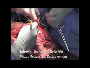 Distal End Femur Radical Excision 1/4 • Video • MEDtube.net